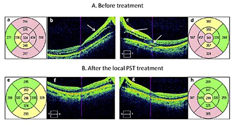 macular edema retinal thickness measurement|macular thickness results.